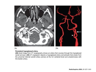 Persistent hypoglossal artery.
(28) Axial image from CT angiography shows an artery that courses through the hypoglossal
canal (arrows). (29) CT angiogram depicts a hypoglossal artery (arrowhead) that arises from
the proximal internal carotid artery (arrow) at the C2 vertebral level and anastomoses with
the basilar artery.

RadioGraphics 2009; 29:1027–1043

 