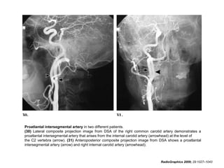 Proatlantal intersegmental artery in two different patients.
(30) Lateral composite projection image from DSA of the right common carotid artery demonstrates a
proatlantal intersegmental artery that arises from the internal carotid artery (arrowhead) at the level of
the C2 vertebra (arrow). (31) Anteroposterior composite projection image from DSA shows a proatlantal
intersegmental artery (arrow) and right internal carotid artery (arrowhead).

RadioGraphics 2009; 29:1027–1043

 