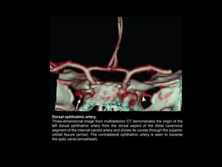 Dorsal ophthalmic artery.
Three-dimensional image from multidetector CT demonstrates the origin of the
left dorsal ophthalmic artery from the dorsal aspect of the distal cavernous
segment of the internal carotid artery and shows its course through the superior
orbital fissure (arrow). The contralateral ophthalmic artery is seen to traverse
the optic canal (arrowhead).

 