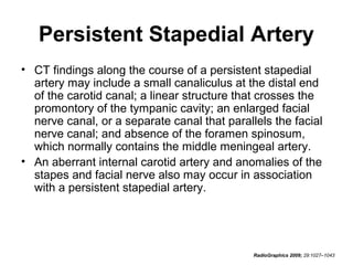 Persistent Stapedial Artery
• CT findings along the course of a persistent stapedial
artery may include a small canaliculus at the distal end
of the carotid canal; a linear structure that crosses the
promontory of the tympanic cavity; an enlarged facial
nerve canal, or a separate canal that parallels the facial
nerve canal; and absence of the foramen spinosum,
which normally contains the middle meningeal artery.
• An aberrant internal carotid artery and anomalies of the
stapes and facial nerve also may occur in association
with a persistent stapedial artery.

RadioGraphics 2009; 29:1027–1043

 