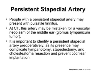 Persistent Stapedial Artery
• People with a persistent stapedial artery may
present with pulsatile tinnitus.
• At CT, this artery may be mistaken for a vascular
neoplasm of the middle ear (glomus tympanicum
tumor).
• It is important to identify a persistent stapedial
artery preoperatively, as its presence may
complicate tympanotomy, stapedectomy, and
cholesteatoma resection and prevent cochlear
implantation.
RadioGraphics 2009; 29:1027–1043

 