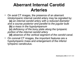 Aberrant Internal Carotid
Arteries
• On axial CT images, the presence of an aberrant
intratympanic internal carotid artery may be signaled by:
(a) an internal carotid artery with a reduced diameter
and a course posterior and parallel to the jugular bulb
(b) a mass in the hypotympanum
(c) deficiency of the bony plate along the tympanic
portion of the internal carotid artery
(d) absence of the vertical segment of the carotid canal.
• On coronal CT images, the important features are a
hypotympanic mass and enlargement of the inferior
tympanic canaliculus.

RadioGraphics 2009; 29:1027–1043

 