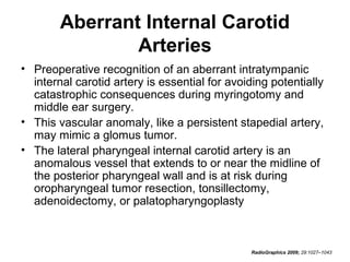 Aberrant Internal Carotid
Arteries
• Preoperative recognition of an aberrant intratympanic
internal carotid artery is essential for avoiding potentially
catastrophic consequences during myringotomy and
middle ear surgery.
• This vascular anomaly, like a persistent stapedial artery,
may mimic a glomus tumor.
• The lateral pharyngeal internal carotid artery is an
anomalous vessel that extends to or near the midline of
the posterior pharyngeal wall and is at risk during
oropharyngeal tumor resection, tonsillectomy,
adenoidectomy, or palatopharyngoplasty

RadioGraphics 2009; 29:1027–1043

 