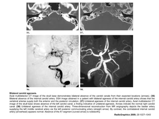 Bilateral carotid agenesis.
Axial multidetector CT image of the skull base demonstrates bilateral absence of the carotid canals from their expected locations (arrows). (36)
Bilateral absence of the internal carotid artery. DSA image obtained in a patient with bilateral agenesis of the internal carotid artery shows that the
vertebral arteries supply both the anterior and the posterior circulation. (37) Unilateral agenesis of the internal carotid artery. Axial multidetector CT
image of the skull base shows absence of the left carotid canal, a finding indicative of unilateral agenesis. Arrows indicate the normal right carotid
canal. (38) Unilateral agenesis of the internal carotid artery. Three-dimensional reconstruction from MR angiography depicts the basilar artery
supplying the left middle cerebral artery via the left posterior communicating artery (straight arrow). By contrast, the contralateral internal carotid
artery (arrowhead) appears normal. Absence of the A1 segment (curved arrow) is noteworthy.
RadioGraphics 2009; 29:1027–1043

 