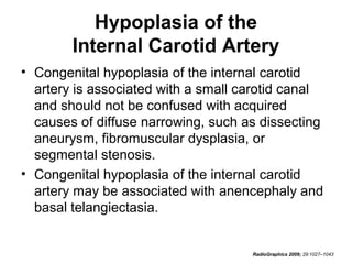 Hypoplasia of the
Internal Carotid Artery
• Congenital hypoplasia of the internal carotid
artery is associated with a small carotid canal
and should not be confused with acquired
causes of diffuse narrowing, such as dissecting
aneurysm, fibromuscular dysplasia, or
segmental stenosis.
• Congenital hypoplasia of the internal carotid
artery may be associated with anencephaly and
basal telangiectasia.

RadioGraphics 2009; 29:1027–1043

 