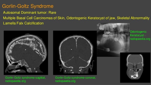 Odontogenic Keratocyst Radiology Ct - Resepi GG