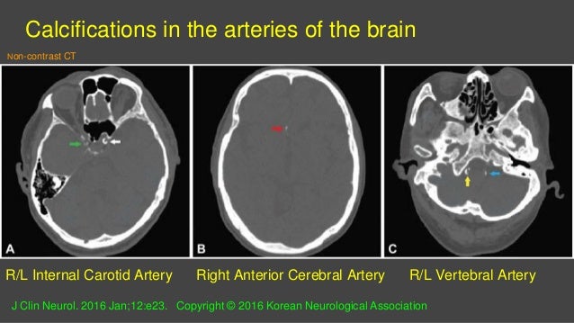 Intracranial Calcification In Cone Beam Ct Medical Ct