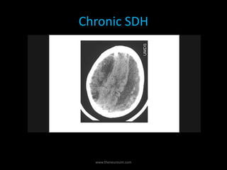 Chronic SDH
www.theneurosim.com
 