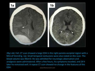 28yr old. Fall. CT scan showed a large EDH in the right parieto-occipital region with a
MLS of 5mm(Fig. 1a). Small temporal contusions were also noted on the scan. The
blood volume was 90cm3. He was admitted for neurologic observation and
analgesics were administered. After a few hours, his symptoms receded, and 24 h
later he remained well. A repeat CT scan showed no change in the features of the
EDH. www.theneurosim.com
 