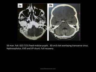 www.theneurosim.com
56 man. Fall. GCS 7/15 fixed midsize pupils. 30 cm3 clot overlaying transverse sinus.
Hydrocephalus. EVD and VP shunt. Full recovery
 