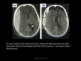 www.theneurosim.com
52 man. Collapse. GCS 14/15 then 6/15. 130cm3 Rt EDH clot with 1mm shift
evacuated. Dense Rt hemiplegia with GCS 13/15 outcome = Kernahon’s Notch
phenomenon.
 