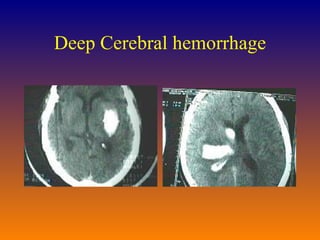 Deep Cerebral hemorrhage 