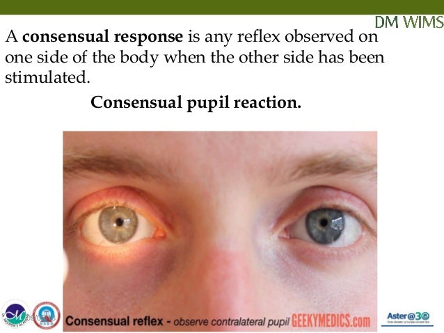 epidural hematoma unequal pupil size epidural hematoma unequal pupil size