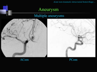 Intracranial hemorrhage dr.manohar | PPTX