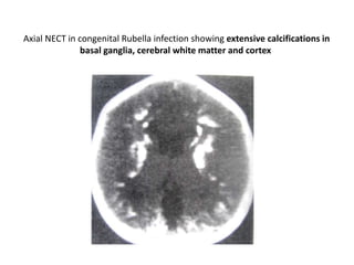 Axial NECT in congenital Rubella infection showing extensive calcifications in
basal ganglia, cerebral white matter and cortex
 