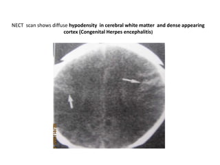 NECT scan shows diffuse hypodensity in cerebral white matter and dense appearing
cortex (Congenital Herpes encephalitis)
 