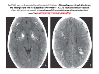 Axial NECT scan in a 5-year-old child with congenital HIV shows 1)bilateral symmetric calcifications in
the basal ganglia and the subcortical white matter . 2). Axial NECT scan in the same patient
shows fairly symmetric punctate and curvilinear calcifications at the gray-white matter junctions
caused by mineralizing microangiopathy.
 