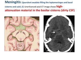 Meningitis 1)purulent exudate filling the leptomeninges and basal
cisterns and sulci; 2) Unenhanced axial CT image shows high-
attenuation material in the basilar cisterns (dirty CSF)
 