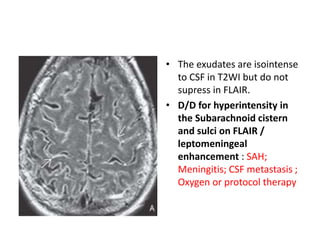 • The exudates are isointense
to CSF in T2WI but do not
supress in FLAIR.
• D/D for hyperintensity in
the Subarachnoid cistern
and sulci on FLAIR /
leptomeningeal
enhancement : SAH;
Meningitis; CSF metastasis ;
Oxygen or protocol therapy
 