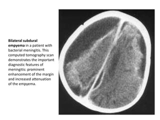 Bilateral subdural
empyema in a patient with
bacterial meningitis. This
computed tomography scan
demonstrates the important
diagnostic features of
meningitis: prominent
enhancement of the margin
and increased attenuation
of the empyema.
 