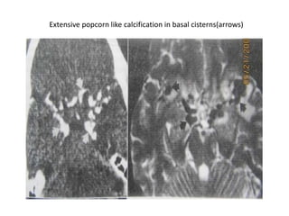 Extensive popcorn like calcification in basal cisterns(arrows)
 