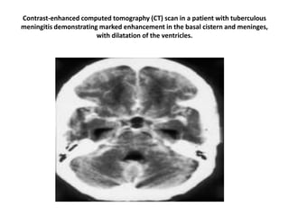 Contrast-enhanced computed tomography (CT) scan in a patient with tuberculous
meningitis demonstrating marked enhancement in the basal cistern and meninges,
with dilatation of the ventricles.
 
