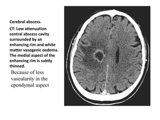 Cerebral abscess.
CT: Low attenuation
central abscess cavity
surrounded by an
enhancing rim and white
matter vasogenic oedema.
The medial aspect of the
enhancing rim is subtly
thinned.
Because of less
vascularity in the
ependymal aspect
 