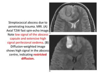 Streptococcal abscess due to
penetrating trauma. MRI. (A)
Axial T2W fast spin-echo image.
Note low signal of the abscess
capsule and extensive high
signal perilesional oedema. (B)
Diffusion-weighted image
shows high signal in the abscess
centre, indicating restricted
diffusion.
 