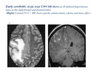 Early cerebritis :(Left) Axial T2WI MR shows an ill-defined hyperintense
mass in the right frontal and parietal lobes.
(Right) Coronal T1 C+ MR shows patchy enhancement, edema and mass effect.
 