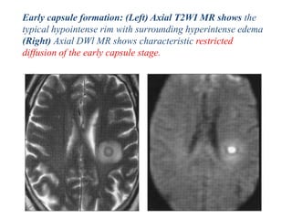 Early capsule formation: (Left) Axial T2WI MR shows the
typical hypointense rim with surrounding hyperintense edema
(Right) Axial DWl MR shows characteristic restricted
diffusion of the early capsule stage.
 