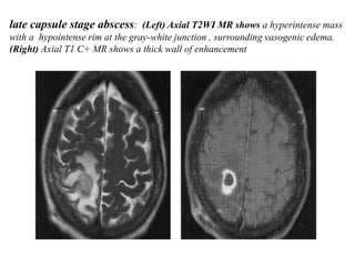 late capsule stage abscess: (Left) Axial T2WI MR shows a hyperintense mass
with a hypointense rim at the gray-white junction , surrounding vasogenic edema.
(Right) Axial T1 C+ MR shows a thick wall of enhancement
 