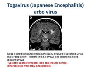 Togavirus (Japanese Encephalitis)
arbo virus
Deep-seated structures characteristically involved: subcortical white
matter (top arrow), thalami (middle arrow), and substantia nigra
(bottom arrow)
Typically spares temporal lobe and insular cortex –
differentiates from HSV encephalitis
 