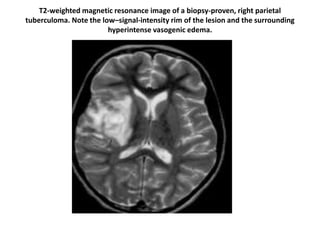 T2-weighted magnetic resonance image of a biopsy-proven, right parietal
tuberculoma. Note the low–signal-intensity rim of the lesion and the surrounding
hyperintense vasogenic edema.
 