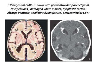 1)Congenital CMV is shown with periventricular parenchymal
calcifications , damaged white matter, dysplastic cortex .
2)Large ventricle, shallow sylvian fissure, periventricular Ca++
 
