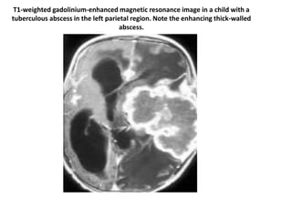 T1-weighted gadolinium-enhanced magnetic resonance image in a child with a
tuberculous abscess in the left parietal region. Note the enhancing thick-walled
abscess.
 