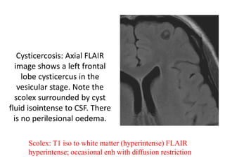 Cysticercosis: Axial FLAIR
image shows a left frontal
lobe cysticercus in the
vesicular stage. Note the
scolex surrounded by cyst
fluid isointense to CSF. There
is no perilesional oedema.
Scolex: T1 iso to white matter (hyperintense) FLAIR
hyperintense; occasional enh with diffusion restriction
 