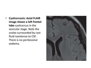 • Cysticercosis: Axial FLAIR
image shows a left frontal
lobe cysticercus in the
vesicular stage. Note the
scolex surrounded by cyst
fluid isointense to CSF.
There is no perilesional
oedema.
 