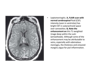 • Leptomeningitis. A, FLAIR scan with
normal cerebrospinal fluid (CSF)
intensity (seen in ventricles) has
bright CSF in subarachnoid space
over convexities. B, Note the
enhancement on this T1-weighted
image deep within the sulci
(arrowheads). Although some of the
enhancement may be attributable to
veins, especially with edematous
meninges, the thickness and smeared
margins argue for pial inflammation.
 