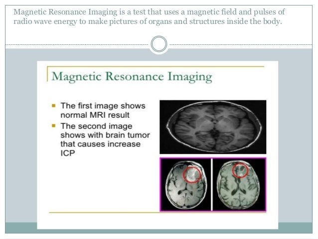 intracranial questions pressure test What Intracranial about should you know pressure