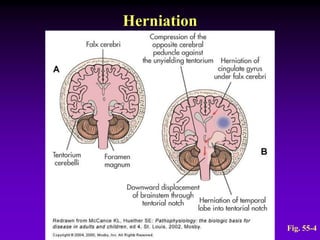 Herniation
Fig. 55-4
 
