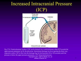 Increased Intracranial Pressure
(ICP)
Copyright © 2011, 2007 by Mosby, Inc., an
affiliate of Elsevier Inc. 19
Fig. 57-8. Ventriculostomy in place. CSF can be drained via a ventriculostomy when ICP exceeds the
upper pressure parameter set by the physician. Intermittent drainage involves opening the three-way
stopcock to allow CSF to flow into the drainage bag for brief periods (30 to 120 seconds) until the
pressure is below the upper pressure parameters. ICP, Intracranial pressure.
 
