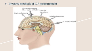 ● Invasive methods of ICP measurement
 