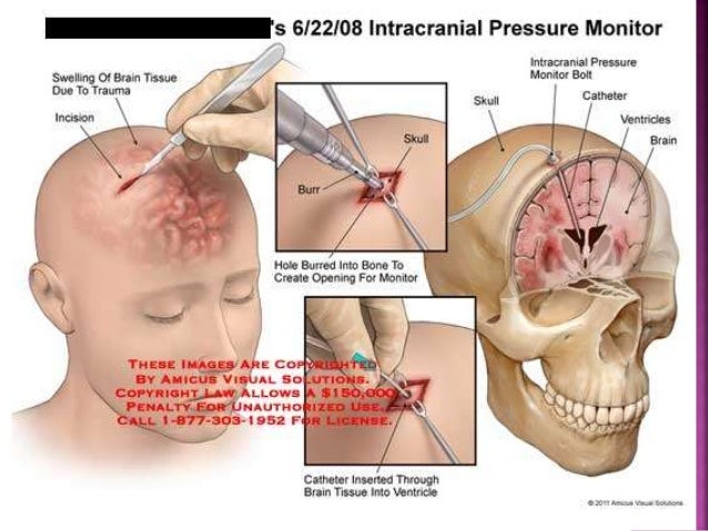 Intracranial Pressure Measurement