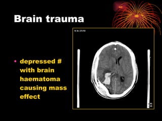 Brain trauma depressed # with brain haematoma causing mass effect  