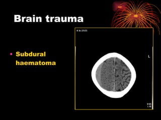 Brain trauma Subdural haematoma 