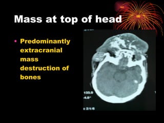 Mass at top of head Predominantly extracranial mass destruction of bones 