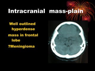 Intracranial  mass-plain Well outlined hyperdense mass in frontal lobe ?Meningioma 