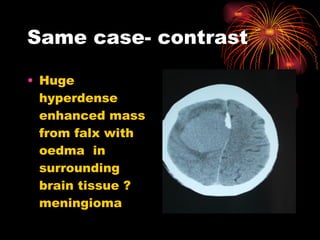 Same case- contrast Huge hyperdense enhanced mass from falx with oedma  in surrounding brain tissue ? meningioma 