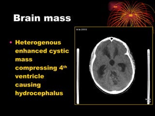 Brain mass  Heterogenous enhanced cystic mass compressing 4 th  ventricle causing hydrocephalus 