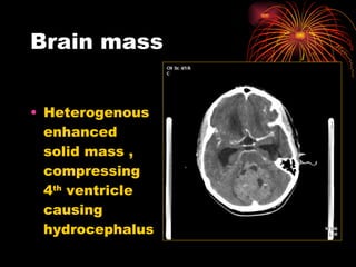 Brain mass  Heterogenous enhanced solid mass , compressing 4 th  ventricle causing hydrocephalus 